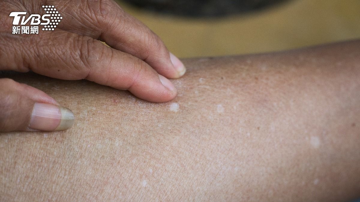 手腳突冒「圓形白點」?醫揭40歲後恐難逃:年紀越大越多