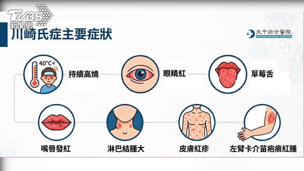川崎氏症主要症狀。（圖／TVBS）
