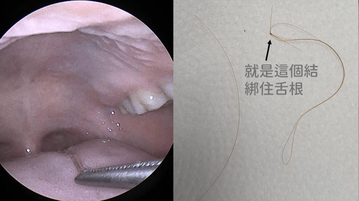 男子被一條長髮勾住舌根上的輪狀乳頭。（圖／翻攝自臉書＠耳鼻喉科 陳世璽醫師）