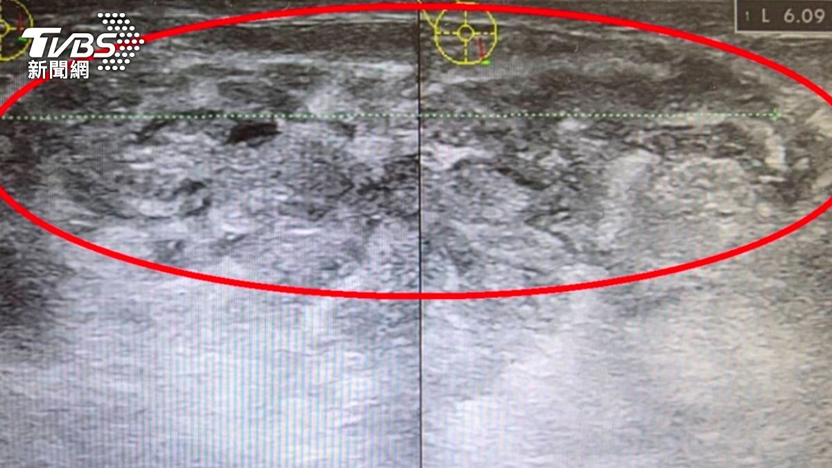 乳房腫塊+高燒不是乳癌？醫揭1罕病　病程拖2年還會復發