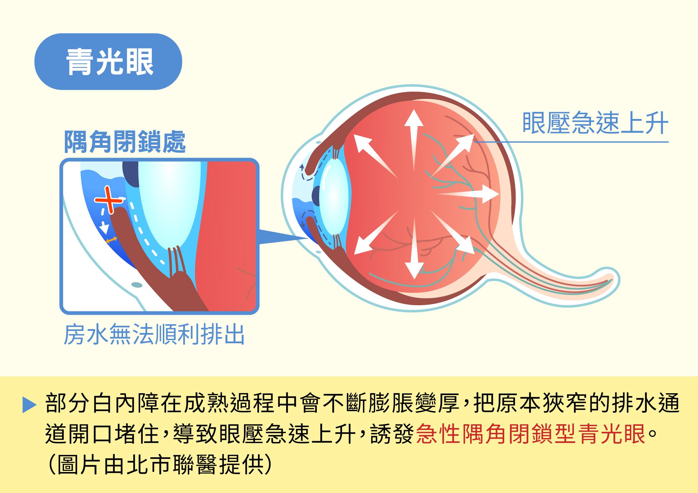 隅角閉鎖型青光眼,因眼部排水通道被堵住。(圖/北市聯醫提供)