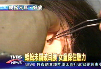 女童趴地上午睡　蜈蚣鑽進耳
