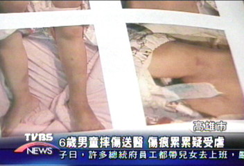 6歲男童摔傷送醫　傷痕累累疑受虐