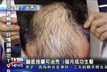 腳底按摩可治禿　3個月成功生髮