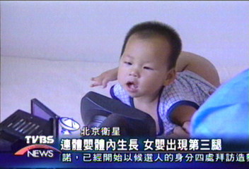 連體嬰體內生長 女嬰出現第三腿
