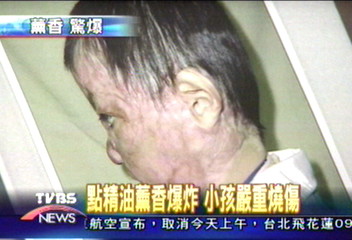 點精油爆炸　小孩嚴重燒傷