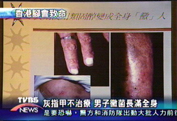 灰指甲不治療 男子黴菌長滿全身