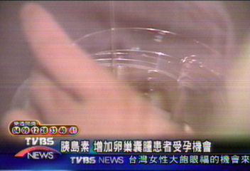 胰島素　增加卵巢囊腫患者受孕機會
