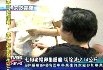 切除14kg卵巢瘤 老婦如釋重負