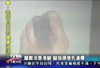 醋酸泡香港腳 腳指頭壞死潰爛