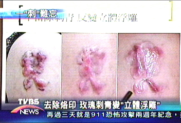 去除烙印 玫瑰刺青變「立體浮雕」