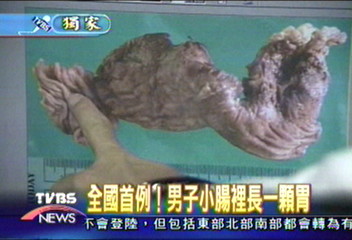 〈獨家〉全國首例！　男子小腸裡長一顆胃