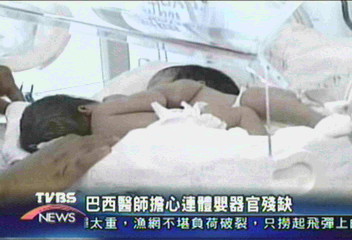 巴西誕生連體女嬰 腹部相連