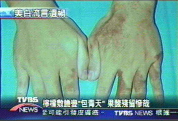 檸檬敷成大黑臉　感光物質作祟