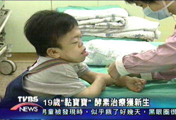 19歲「黏寶寶」 酵素治療獲新生
