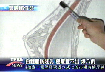 自體脂肪豐胸 篩檢乳癌困難