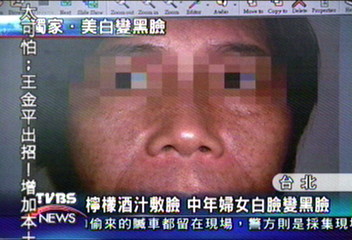 〈獨家〉檸檬酒汁敷臉　中年婦女白臉變黑臉