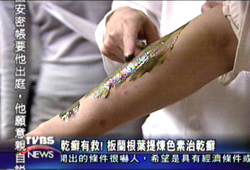 乾癬有救！板蘭根葉提煉色素治乾癬