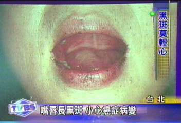 嘴唇長黑斑 小心癌症病變