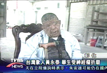 台灣象人黃永泰　畢生受神經瘤折磨