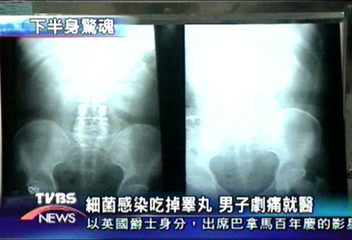 細菌感染吃掉睪丸 男子劇痛就醫