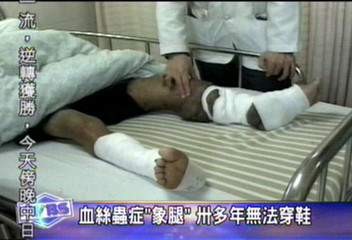 血絲蟲症「象腿」　30多年無法穿鞋