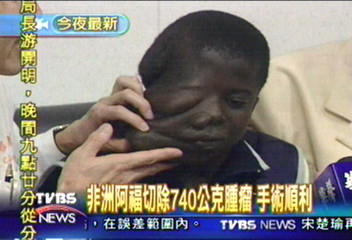 〈獨家〉非洲阿福切除740公克腫瘤　手術順利
