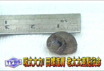 吸太大力　田螺進肺　老太太差點沒命