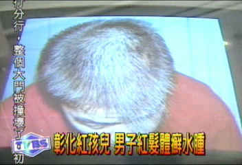 彰化紅孩兒　男子紅髮體癬水腫