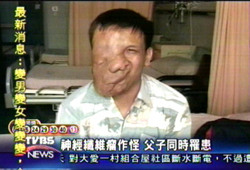 神經纖維瘤作怪 父子同時罹患