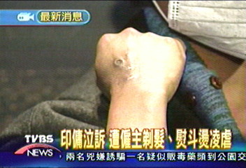 遭僱主凌虐 印傭全身傷痕累累