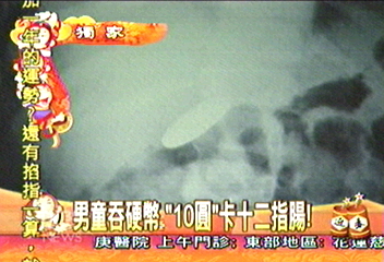 〈獨家〉男童吞硬幣 10圓卡十二指腸
