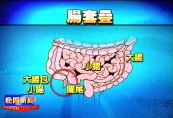 男童腹痛嘔吐　大腸包小腸差點沒命