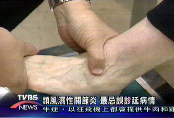 類風濕性關節炎　發病無前兆
