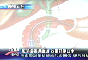 氣球擴張通膽道　效果好傷口小