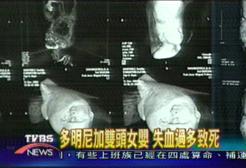 雙頭女嬰分割成功 但失血致死