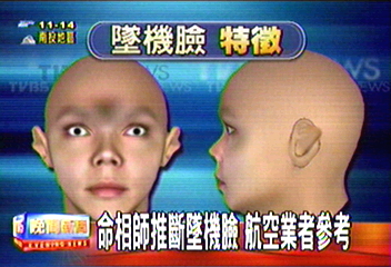 「墜機臉」特徵　眼露白　朝天鼻　耳骨突