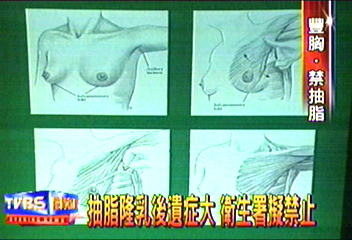 抽脂隆乳後遺症大 衛生署擬禁止