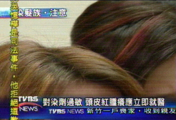 永遠禿了 染髮引發後腦勺頭皮潰爛