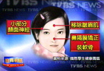 頭不痛了 拉皮隆鼻兼治療偏頭痛