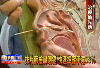 抹片篩檢鼻咽癌　快速無痛準確率高
