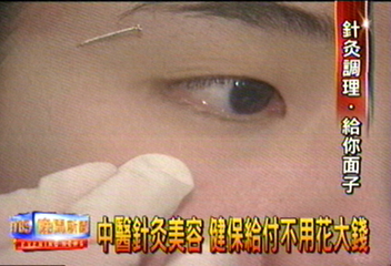 中醫針灸美容 健保給付不用花大錢
