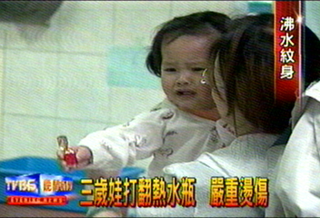 三歲娃打翻熱水瓶　嚴重燙傷