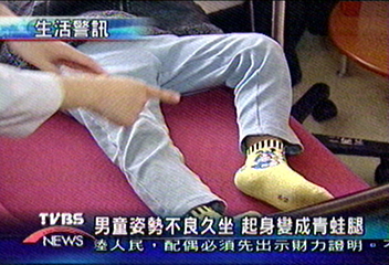 男童姿勢不良久坐　 起身變成青蛙腿