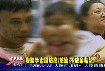 印尼小象人「阿狄」 跨海變臉手術