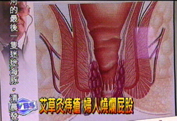 艾草灸痔瘡 婦人燒爛屁股