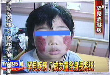 罕見疾病 8歲女童全身長紫斑