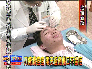 刀療清痘痘 兩天痊癒傷口不留疤
