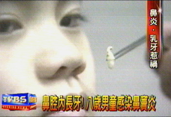 鼻腔內長牙！　8歲男童感染鼻竇炎