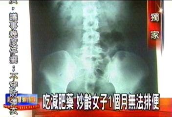〈獨家〉吃減肥藥 妙齡女子1個月無法排便